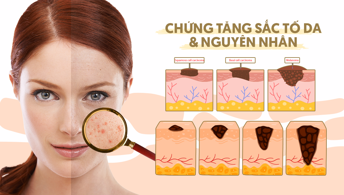 Nguyên nhân gây tăng sắc tố da