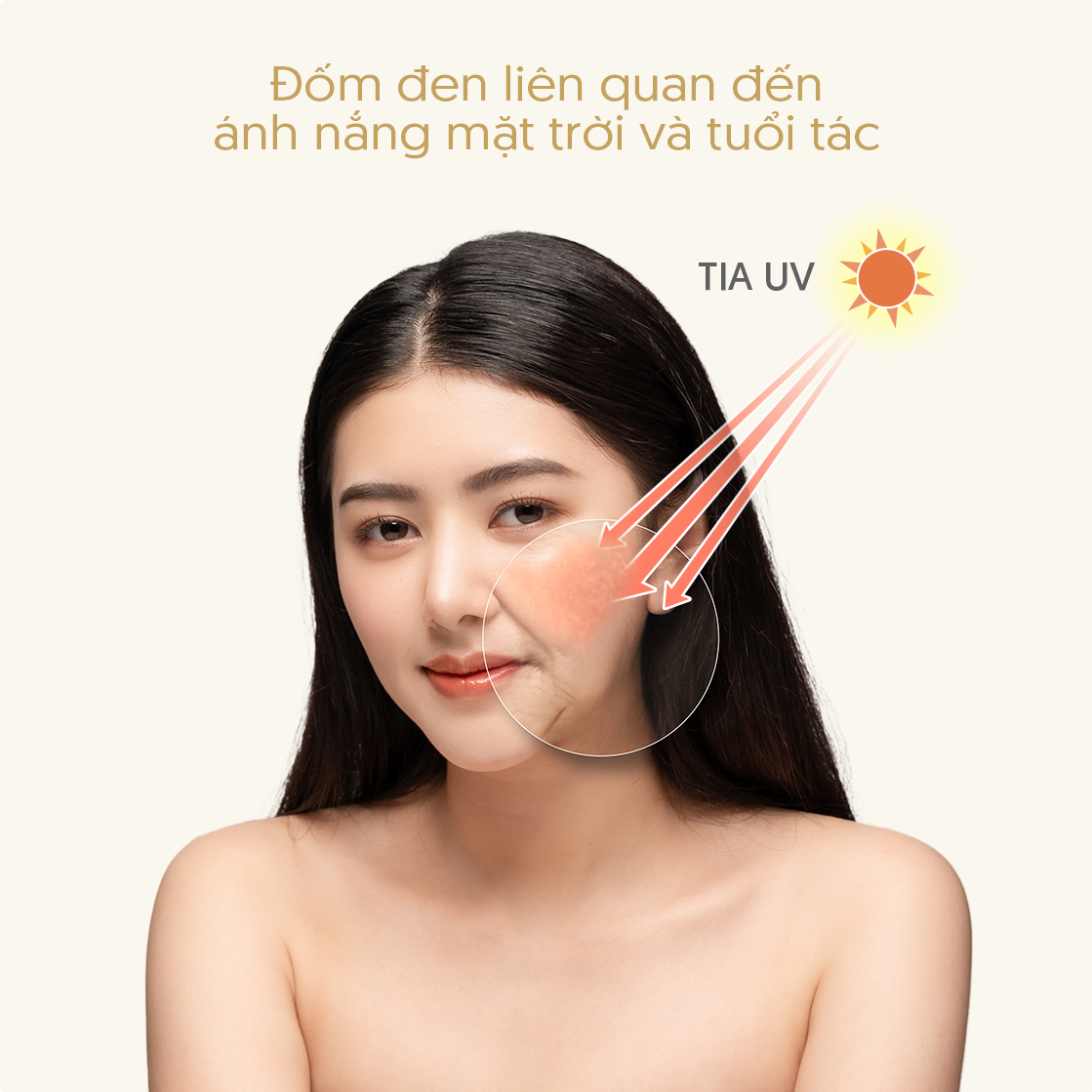 Đốm đen liên quan đến ánh nắng mặt trời và tuổi tác