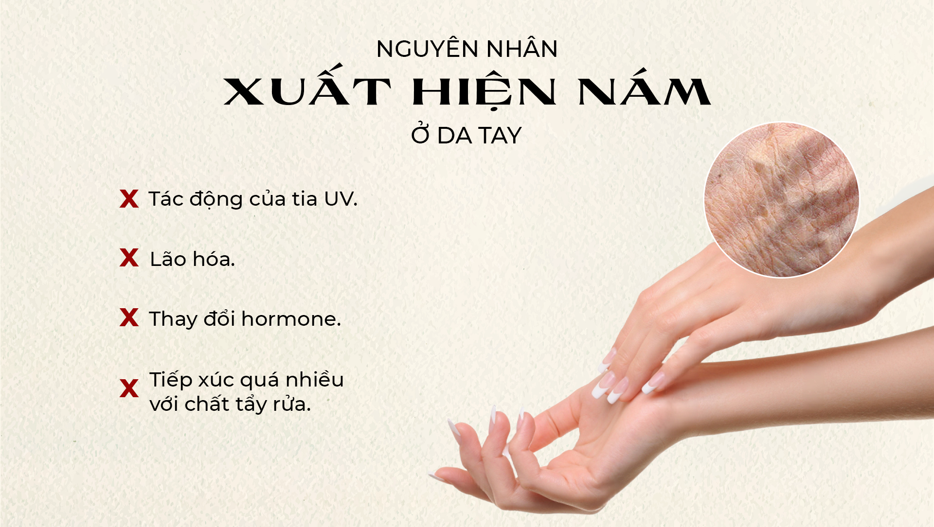 Nguyên nhân xuất hiện nám ở da tay