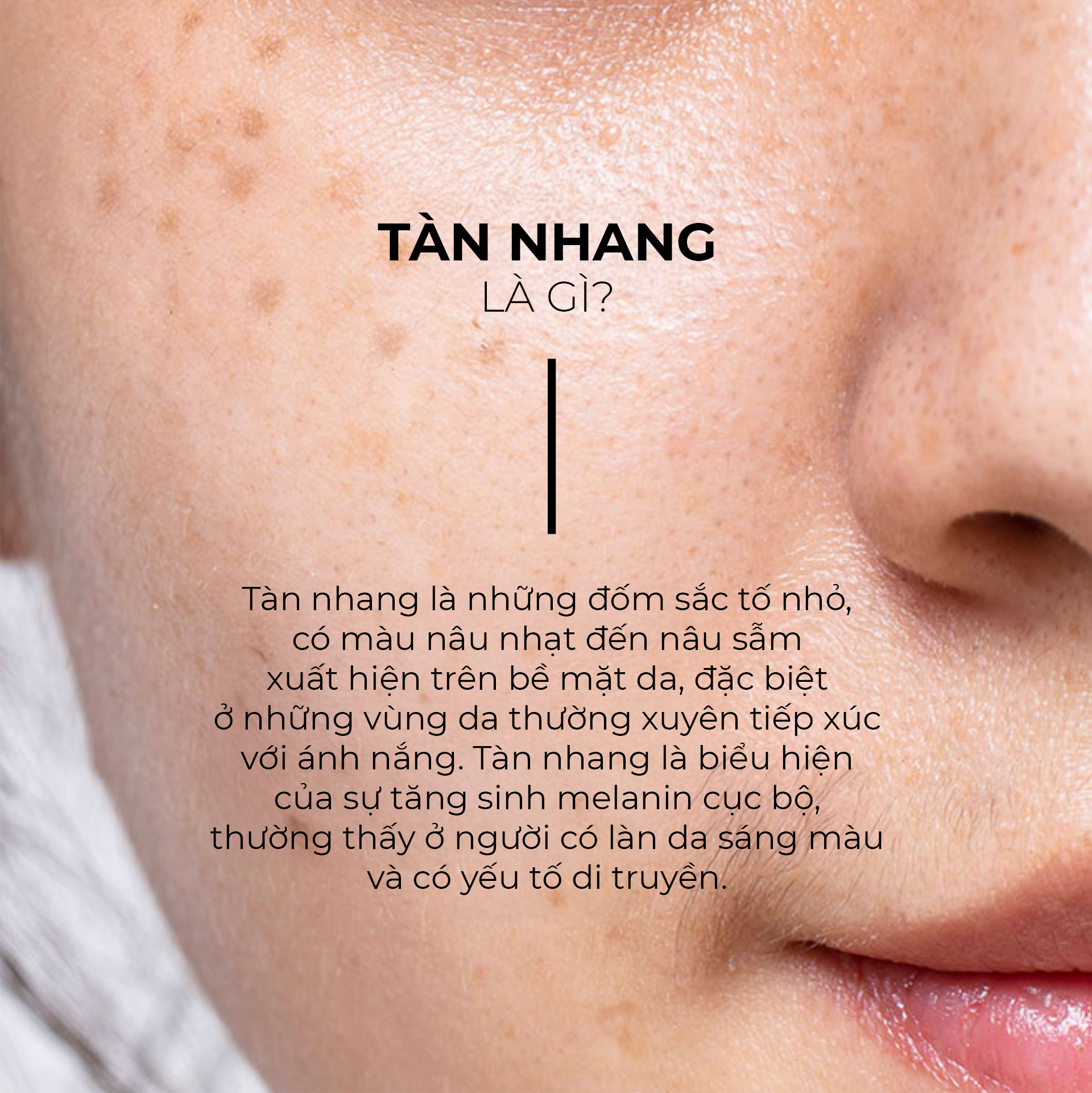 Tàn nhang là gì
