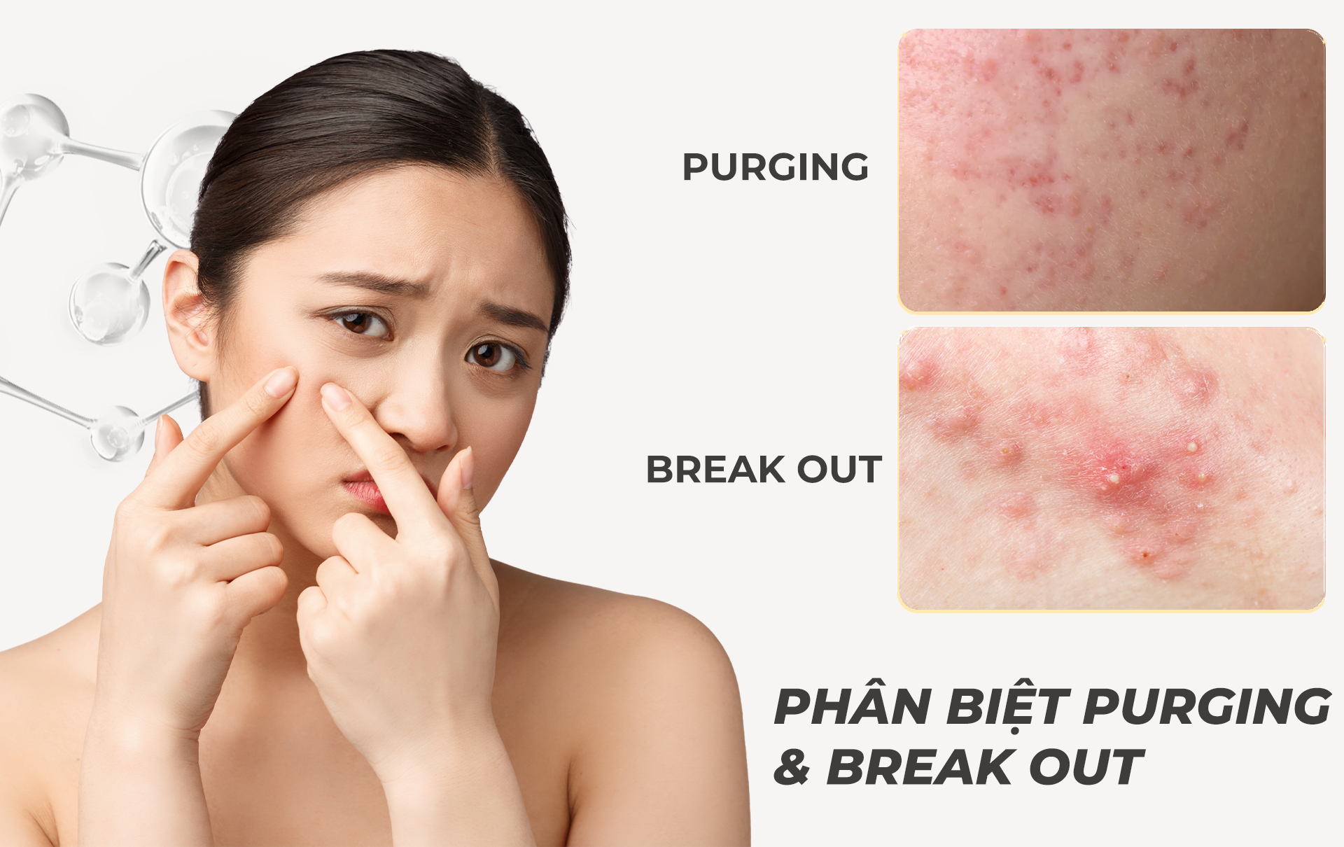 Phân biệt purging và break out