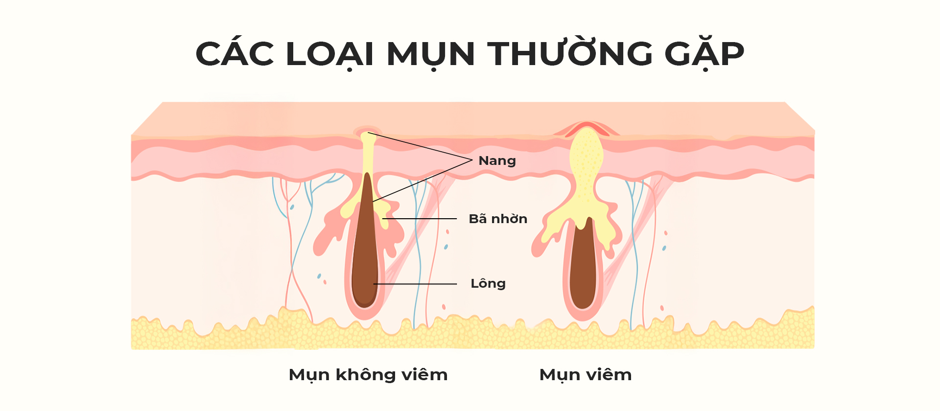 Các loại mụn thường gặp